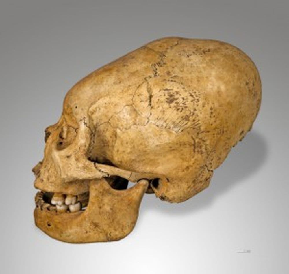 Schädedeformierung durch Inka. Photo Credit: Wikipedia Commons